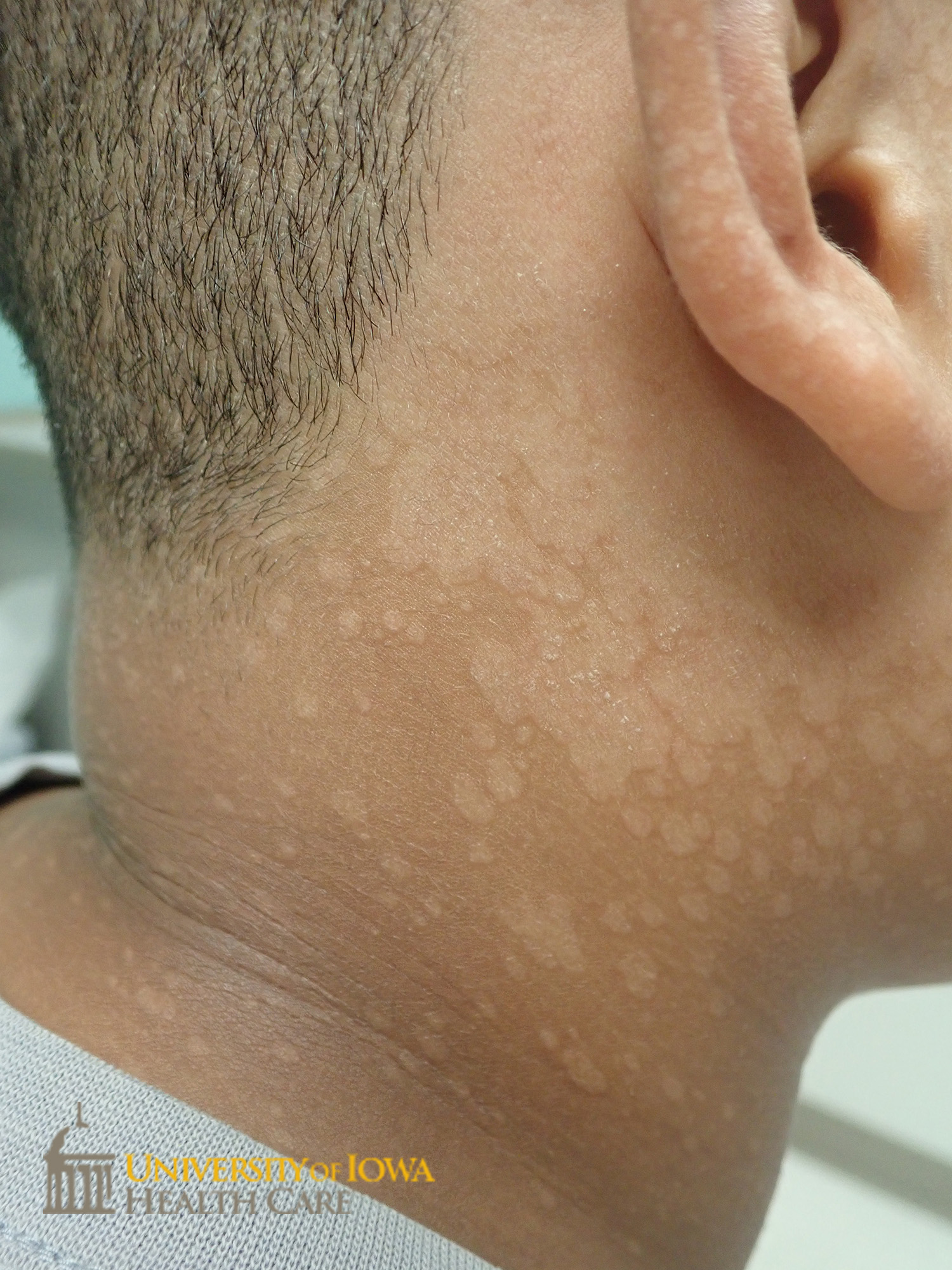 Hypopigmented slightly scaly thin confluent plaques on the posterior neck, ear, and back. (click images for higher resolution).